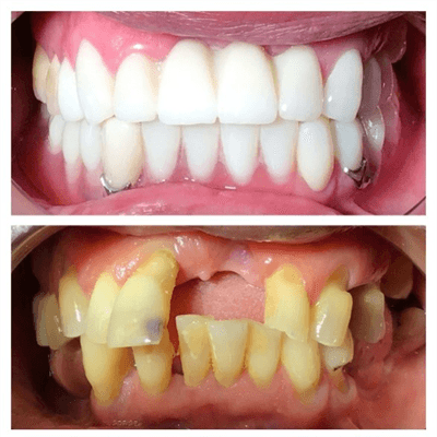 Dentures and Partials Photo