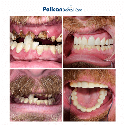 Before and after photo of a full upper arch reconstruction performed at Pelican Dental Care in Vero Beach, Florida. Photo